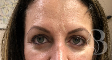 Dysport - Brow Lift before