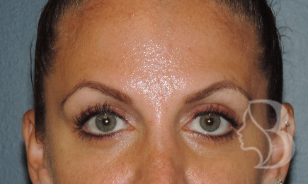 Dysport - Brow Lift after