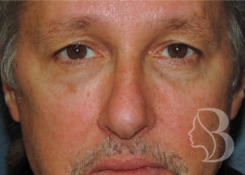 Upper Blepharoplasty before