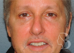 Upper Blepharoplasty after