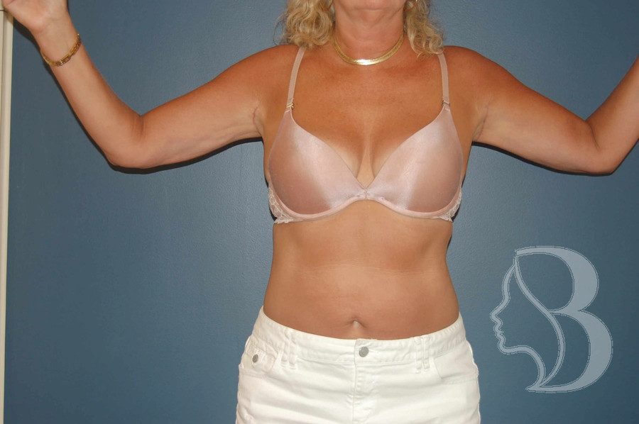 Arm Lift after