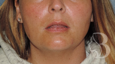 Lip Filler - Restylane Silk before