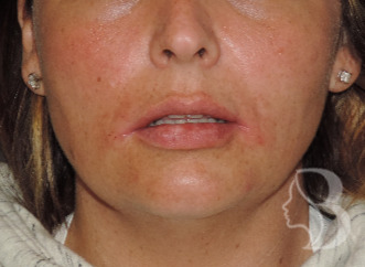 Lip Filler - Restylane Silk after
