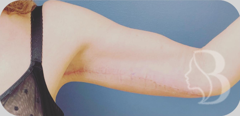 Arm Lift after