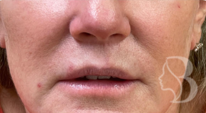 Lip Filler - Philtral Columns before