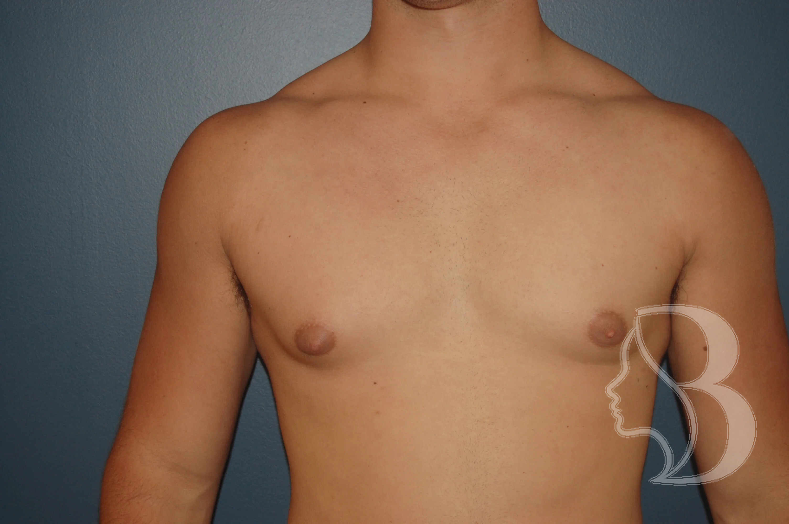 Male Breast Reduction before