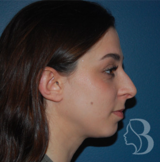 Rhinoplasty before
