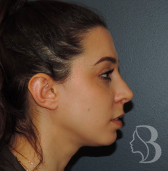 Rhinoplasty after