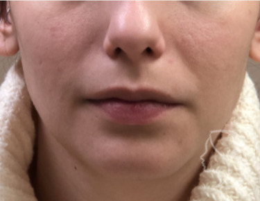 Lip Filler - Restylane Silk before