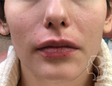 Lip Filler - Restylane Silk after