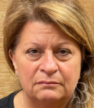 Lower Blepharoplasty, Rafi Stitch, Fat Transposition before