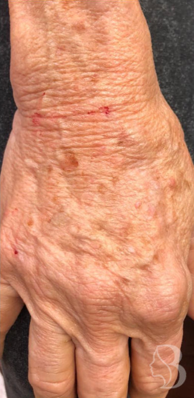 Hand Rejuvenation - Restylane Lyft after