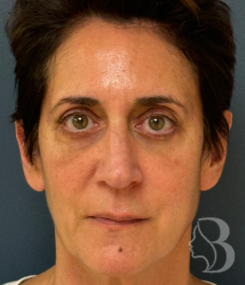 Lower Blepharoplasty, Rafi Stitch, Fat Transposition after