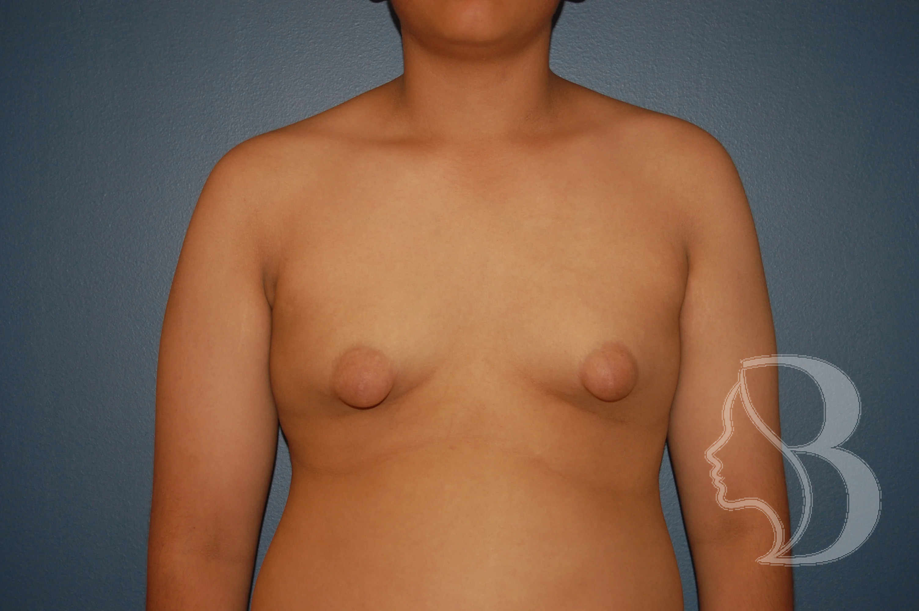 Male Breast Reduction before