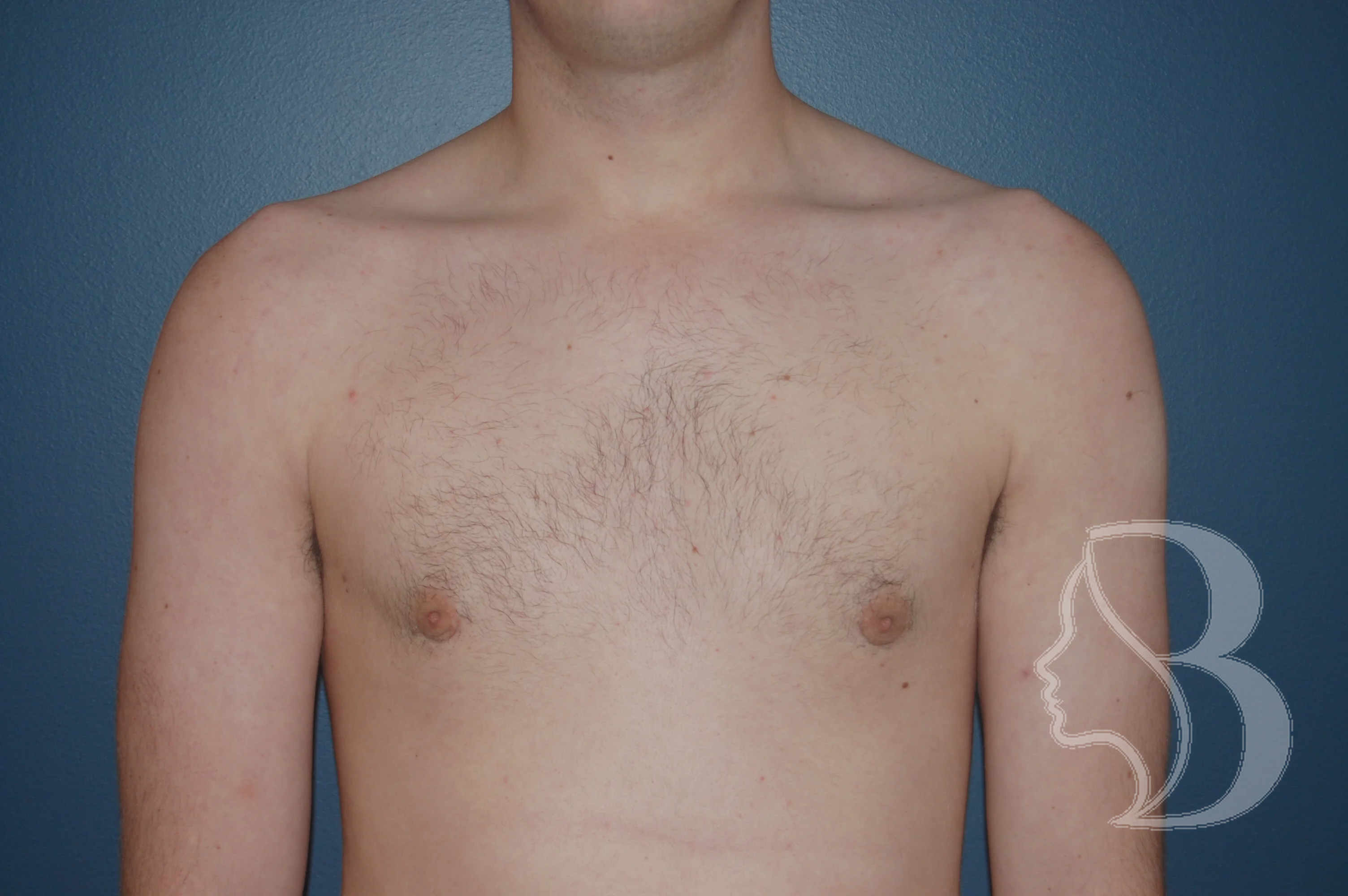 Male Breast Reduction after