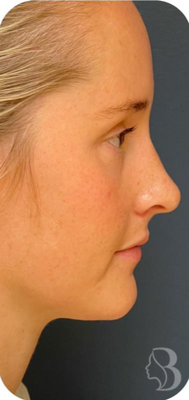 Rhinoplasty after