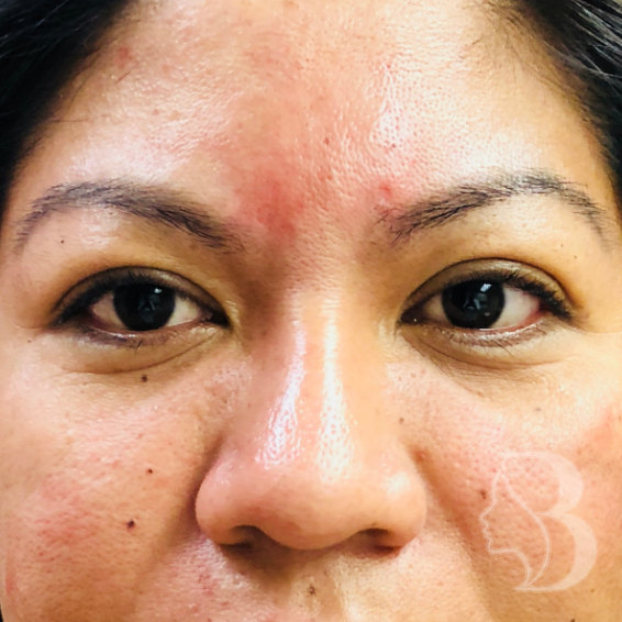 Glabellar Filler - Restylane after