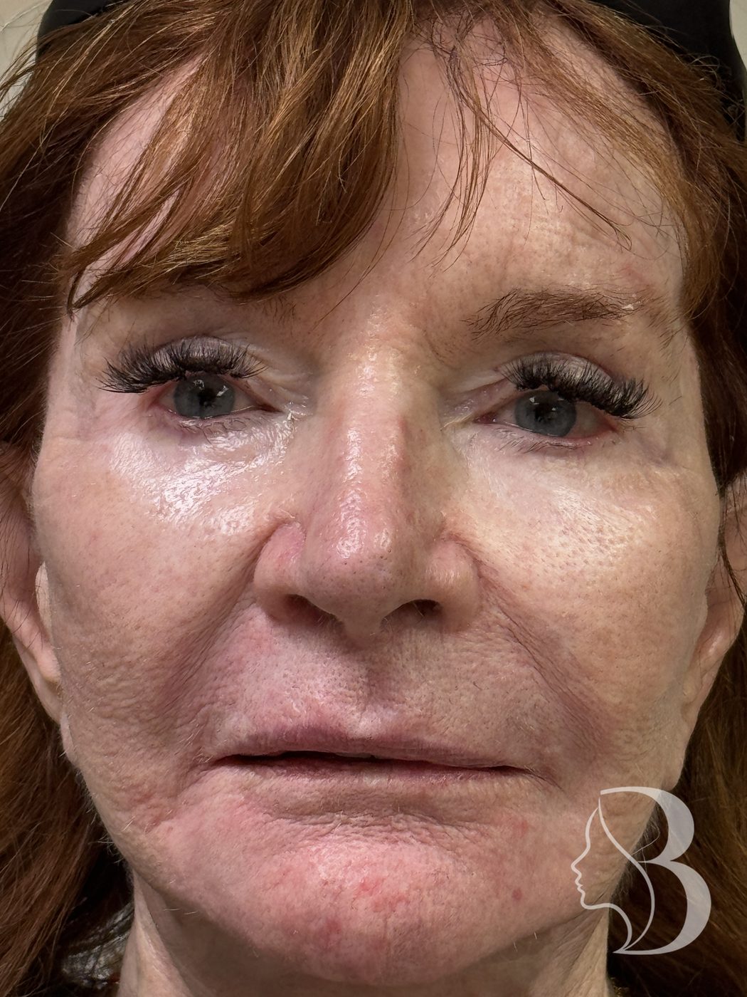 Lip, philtral column, nasolabial fold and cheek filler with Restylane Kysse and Lyft — before