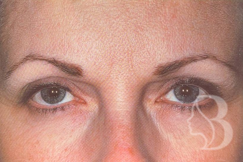 Frown lines (glabella) after neuromodulator treatment