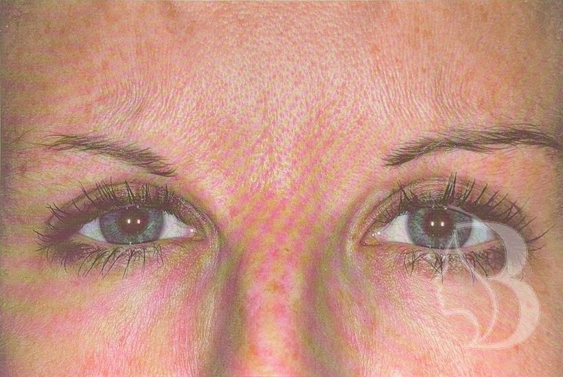 Frown lines (glabella) after neuromodulator treatment