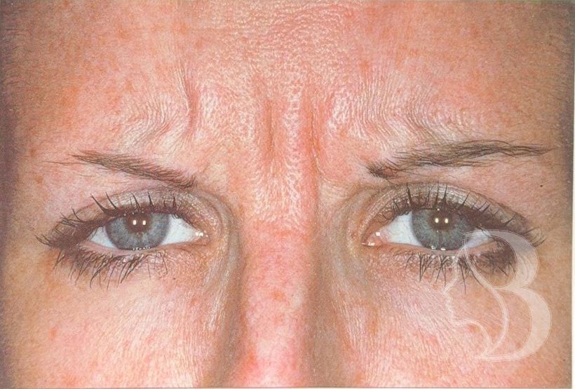 Frown lines (glabella) before neuromodulator treatment