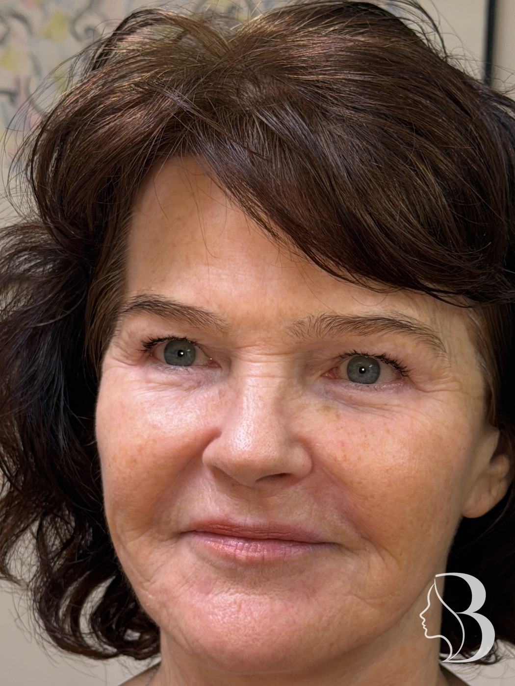 Lip volume and perioral softening with Restylane, plus Dysport lip flip, crow's feet and brow — before