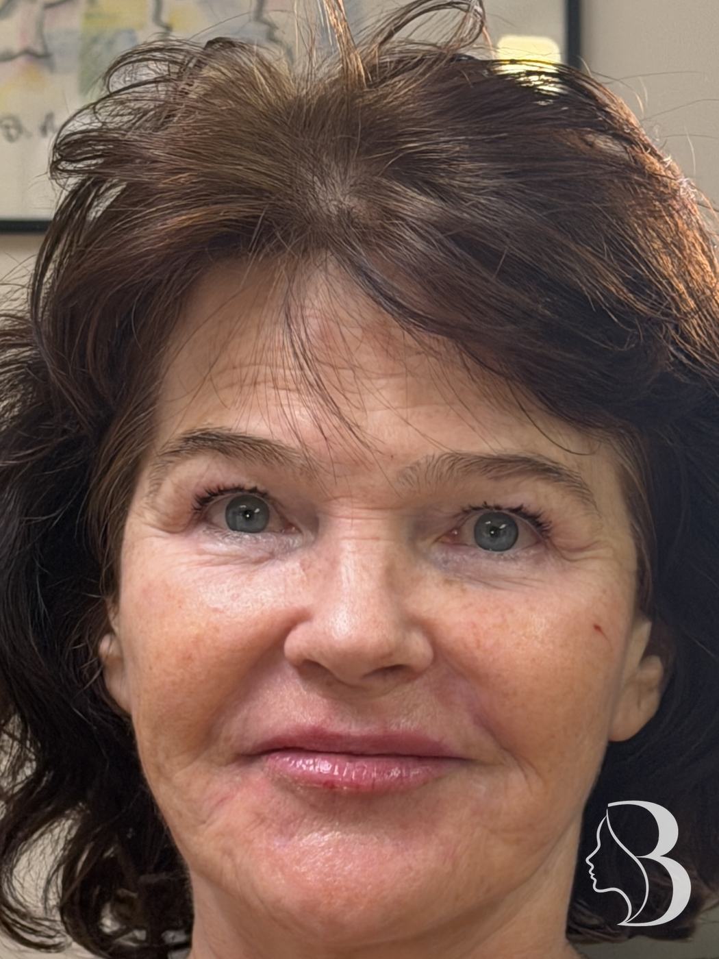 Lip volume and perioral softening with Restylane, plus Dysport lip flip, crow's feet and brow — after