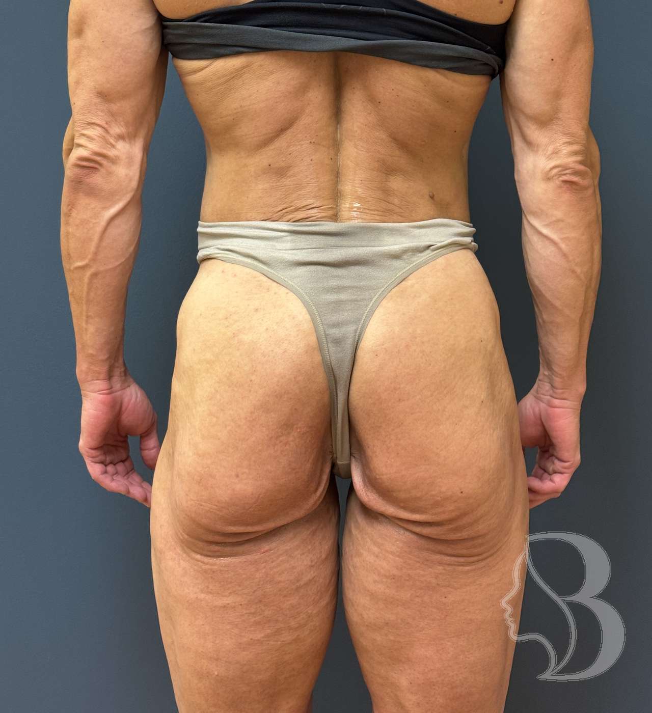 AlloClae injectable to the gluteal fold — before