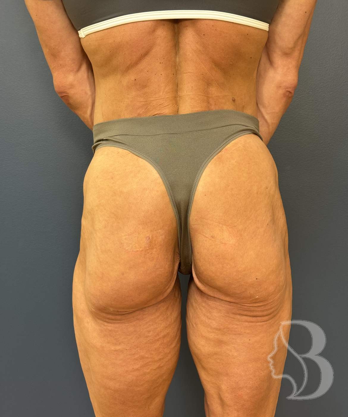 AlloClae injectable to the gluteal fold — after