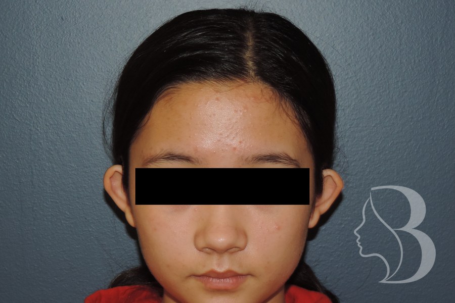Otoplasty before