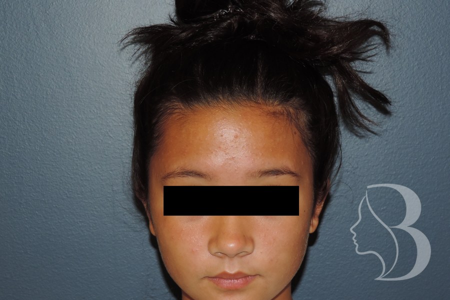 Otoplasty after