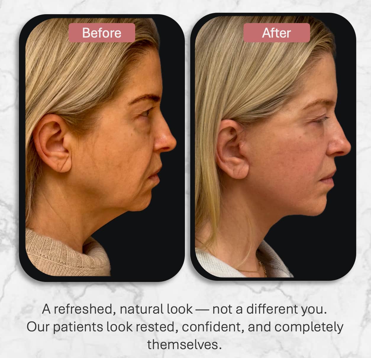 Deep plane facelift before and after — natural profile result, Dr. Rafizadeh Morristown NJ