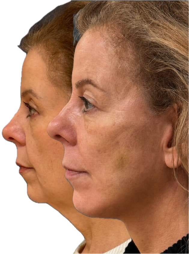 Deep plane facelift — 1 week post-op before and after profile, Dr. Rafizadeh Morristown NJ