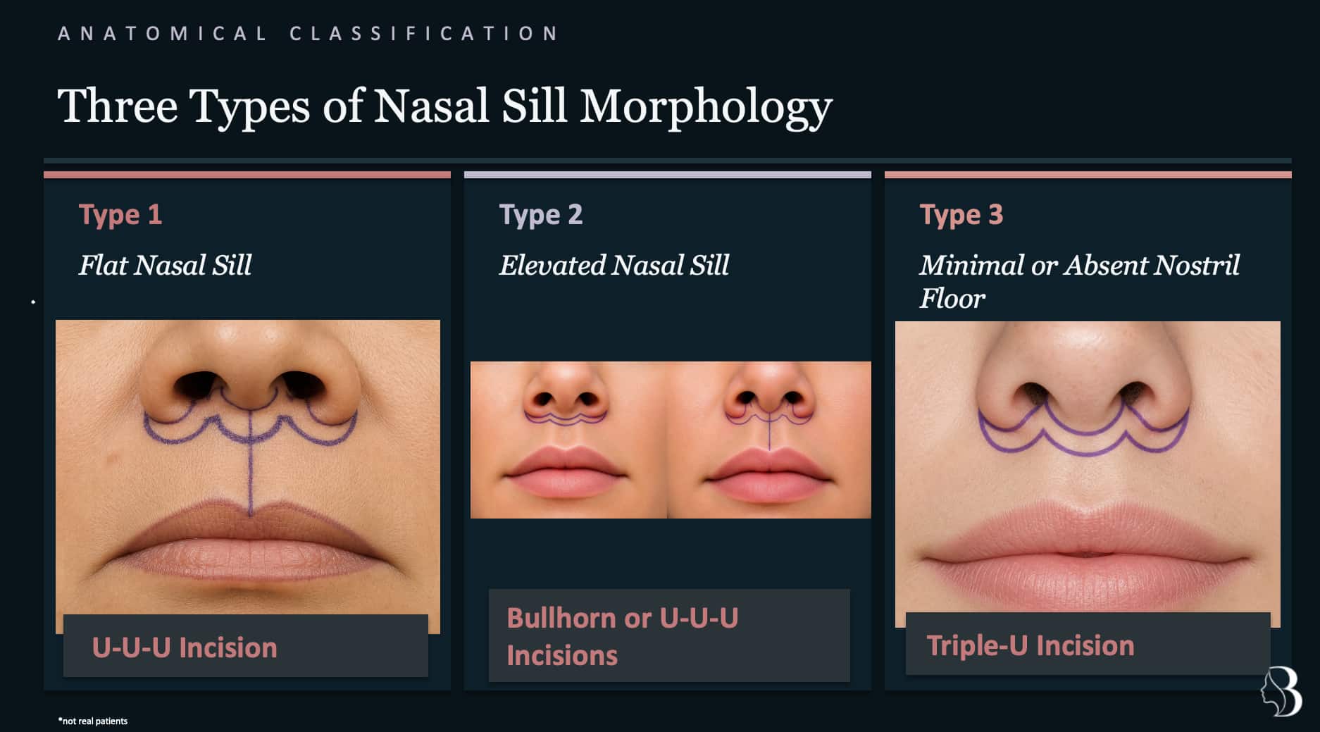 Three types of nasal sill morphology for lip lift incision planning — Dr. Rafizadeh