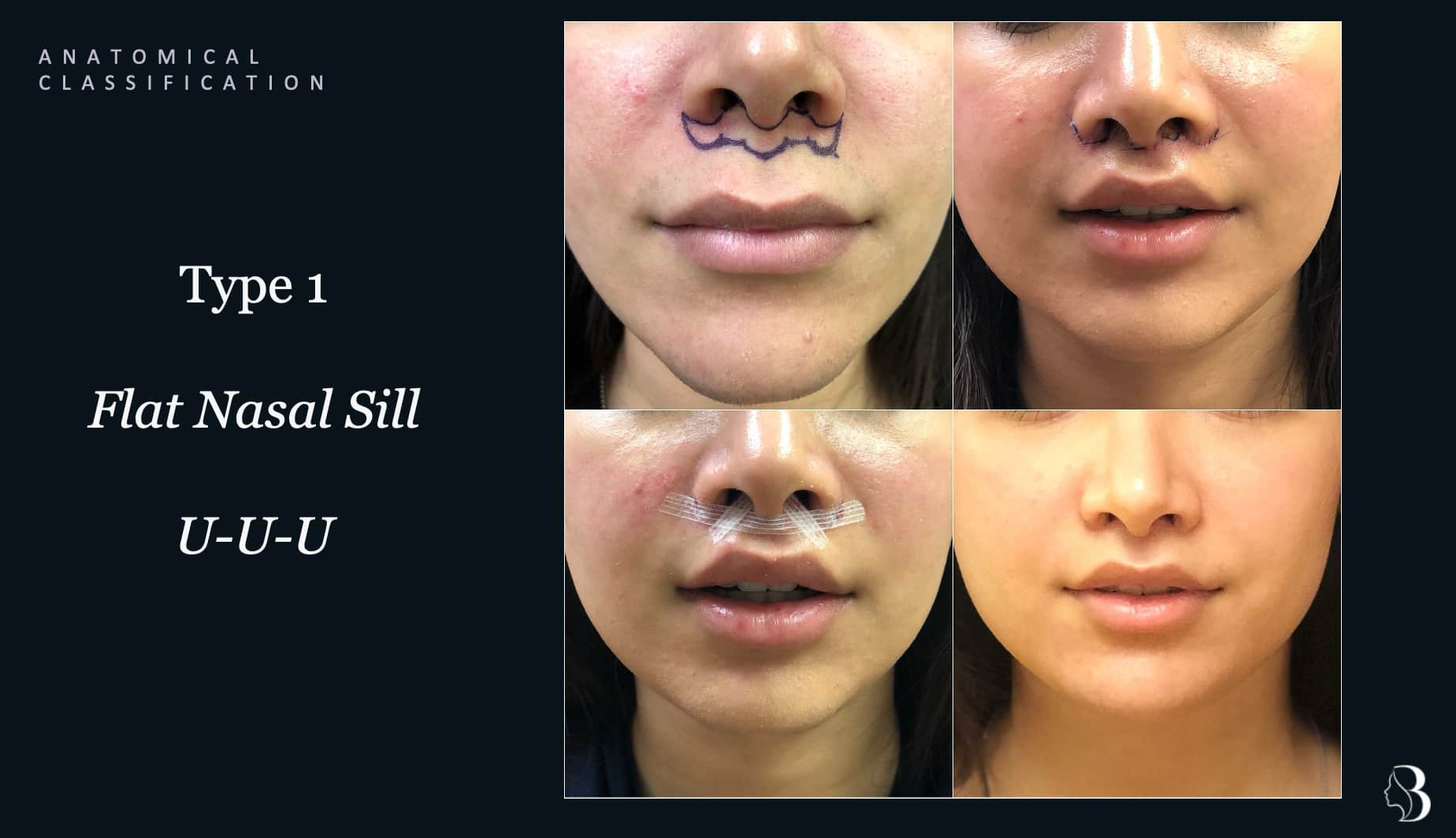 Type 1 flat nasal sill — U-U-U incision lip lift