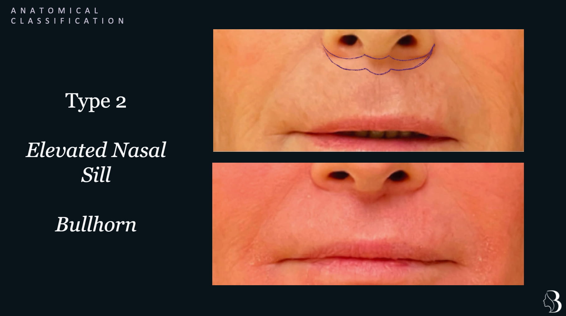 Type 2 elevated nasal sill — bullhorn incision lip lift