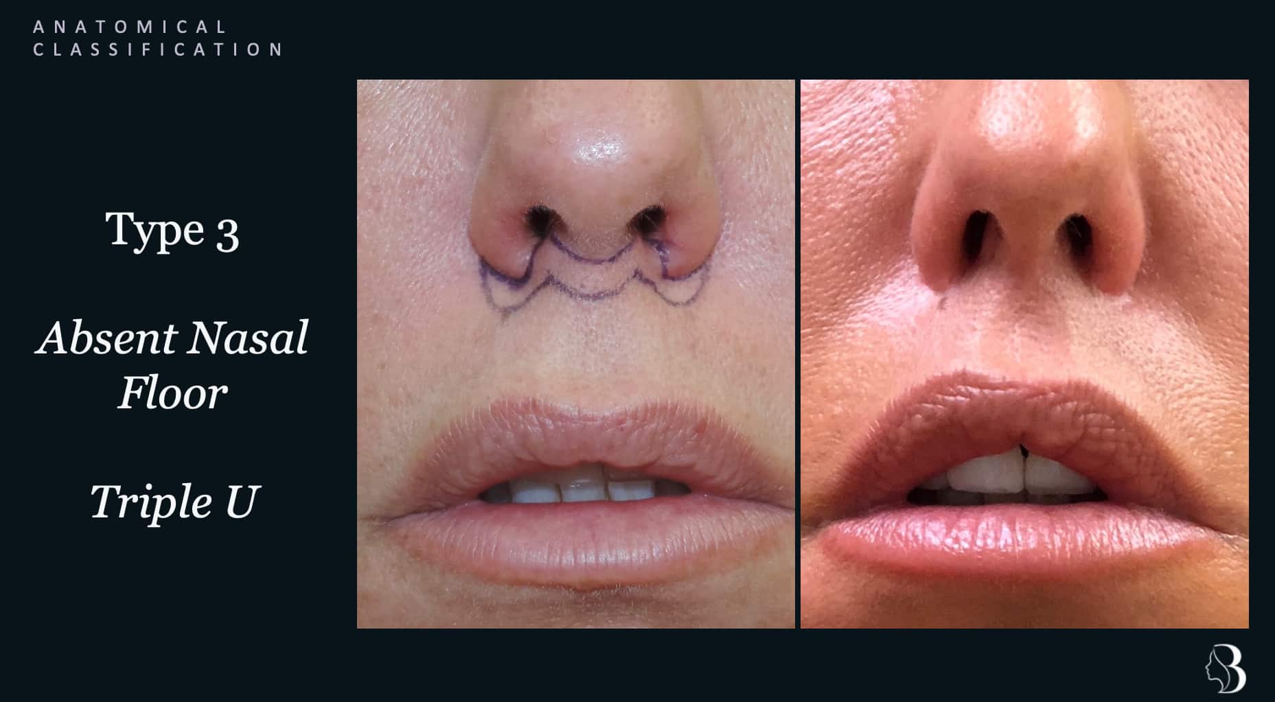 Type 3 absent nasal floor — triple-U incision lip lift